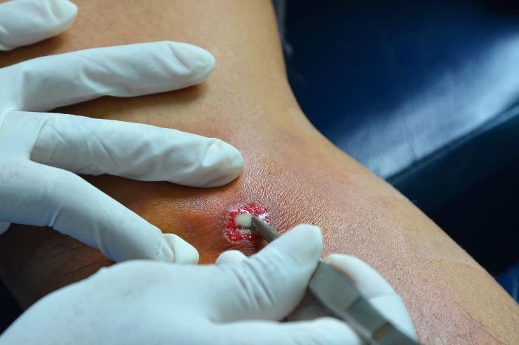 Abscess-Drainage