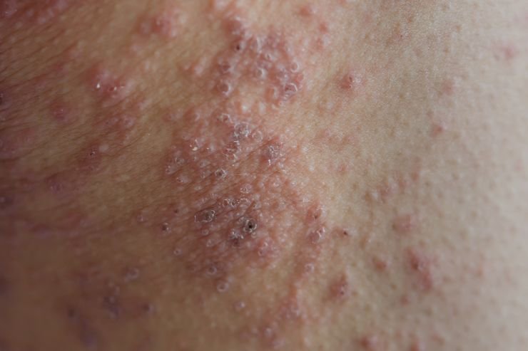 Allergic-Rash