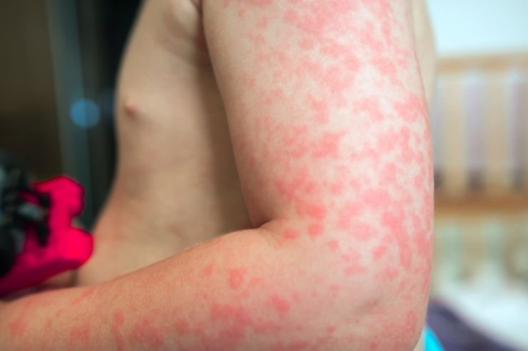 Childhood-Skin-Diseases