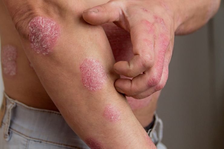 Eczema