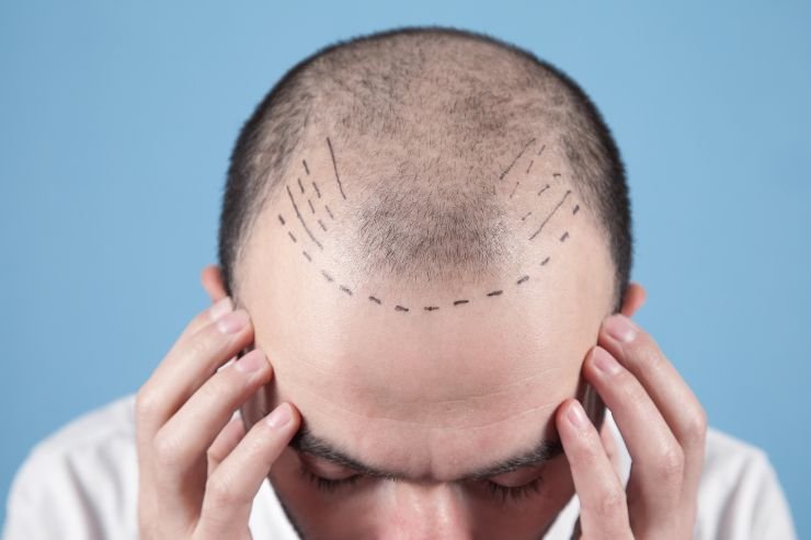 Hair-Transplantation