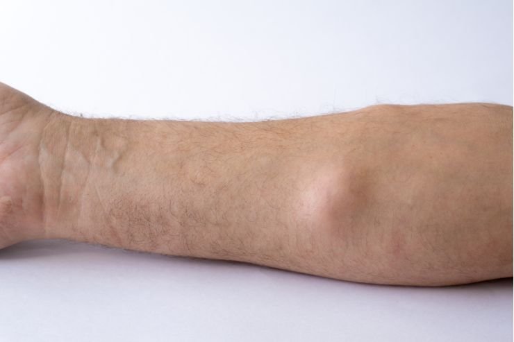 Lipoma