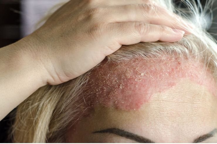 Psoriasis