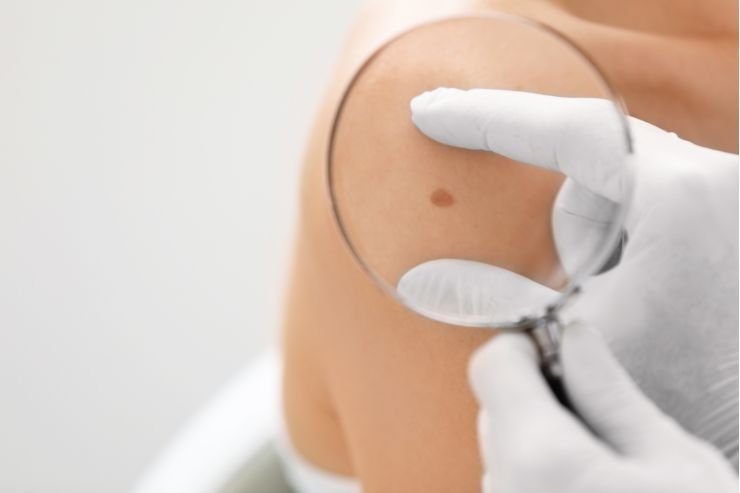 Skin-Biopsy