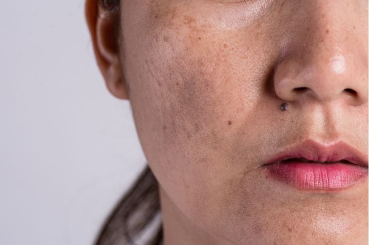 Skin-Pigmentation