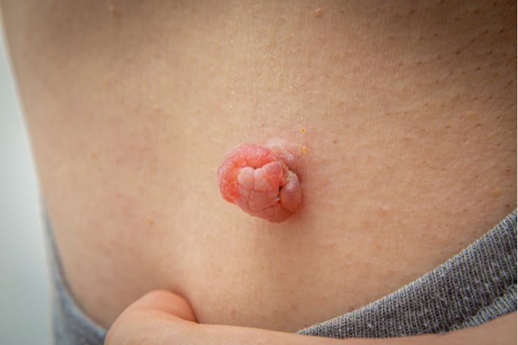 Skin-Tags