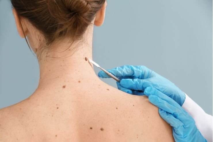 Surgery-for-Moles