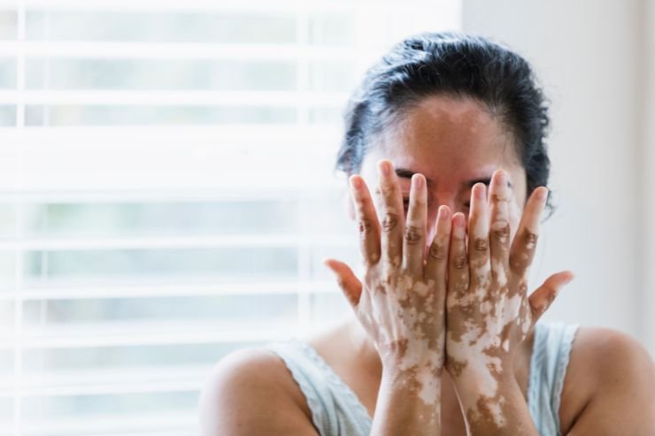 Vitiligo