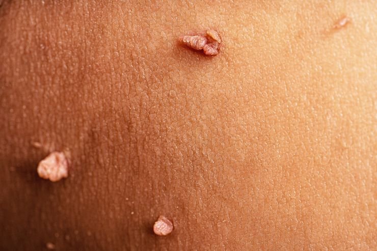 Warts