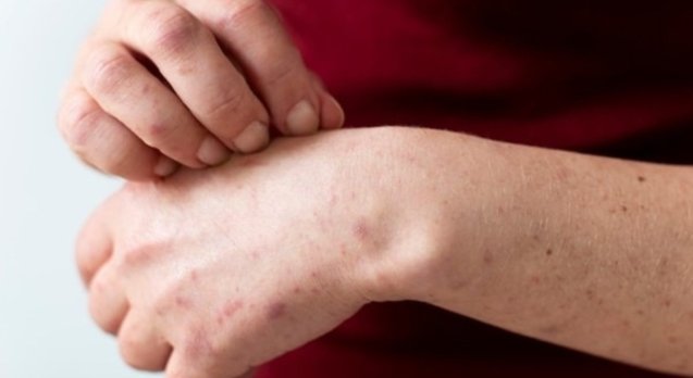 Dermatitis:-Causes,-Symptoms,-and-More