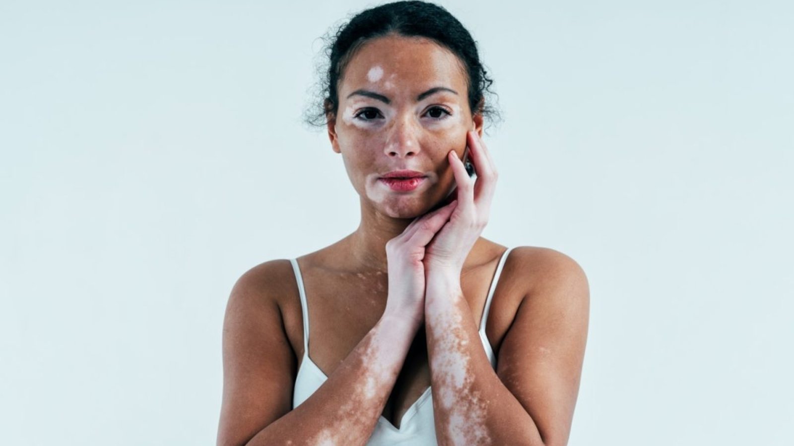 Vitiligo-Treatment-Options:-A-Comprehensive-Guide