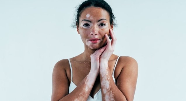 Vitiligo-Treatment-Options:-A-Comprehensive-Guide