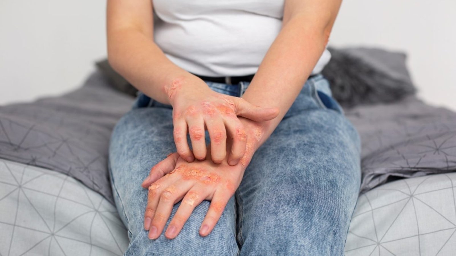 Living-with-Psoriasis:-Coping-Strategies-and-Support-Resources