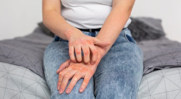Living-with-Psoriasis:-Coping-Strategies-and-Support-Resources