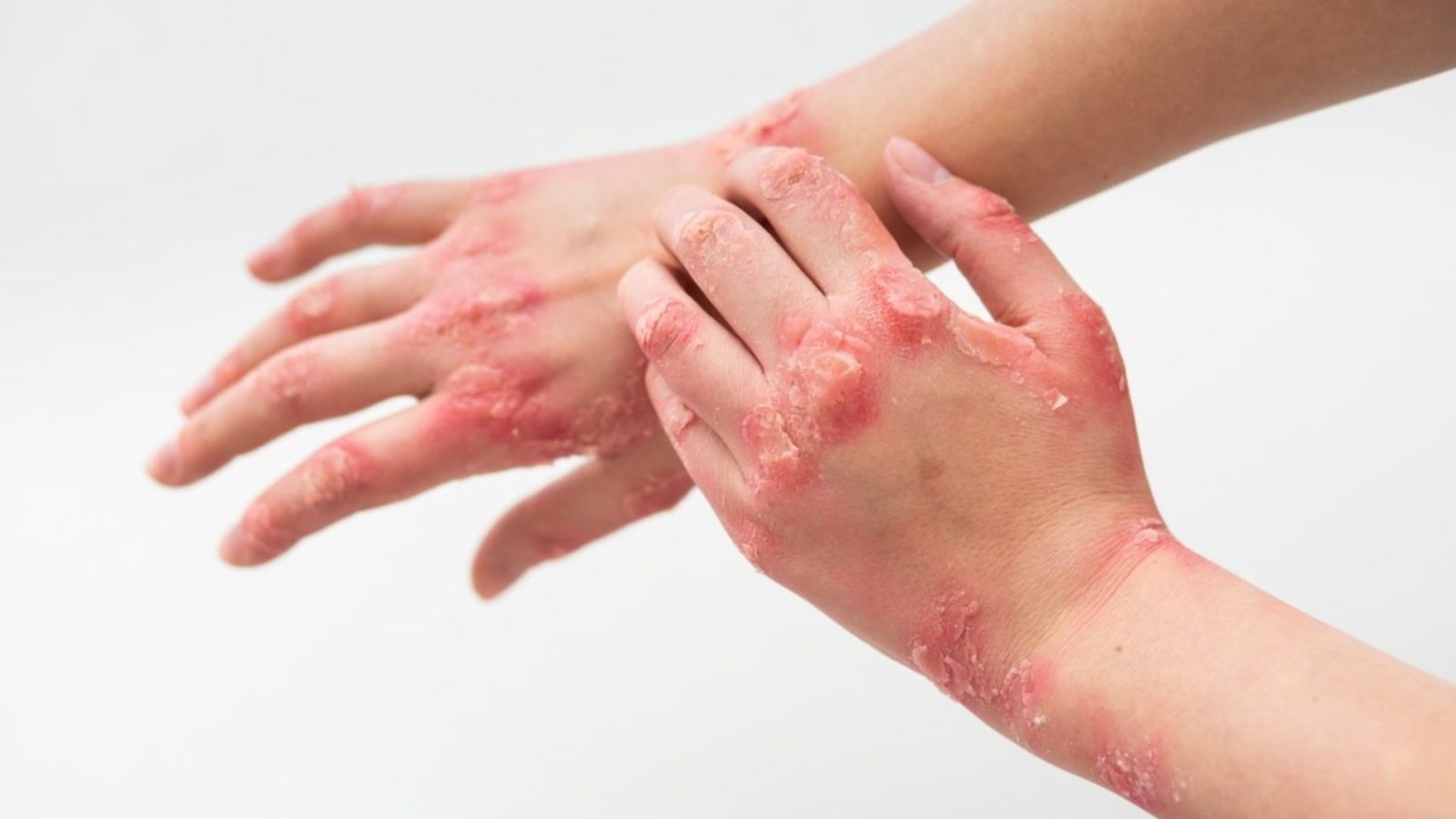Everything-You-Should-Know-About-Psoriasis