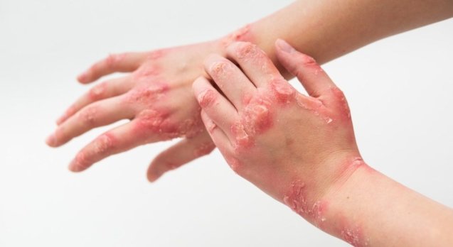 Everything-You-Should-Know-About-Psoriasis