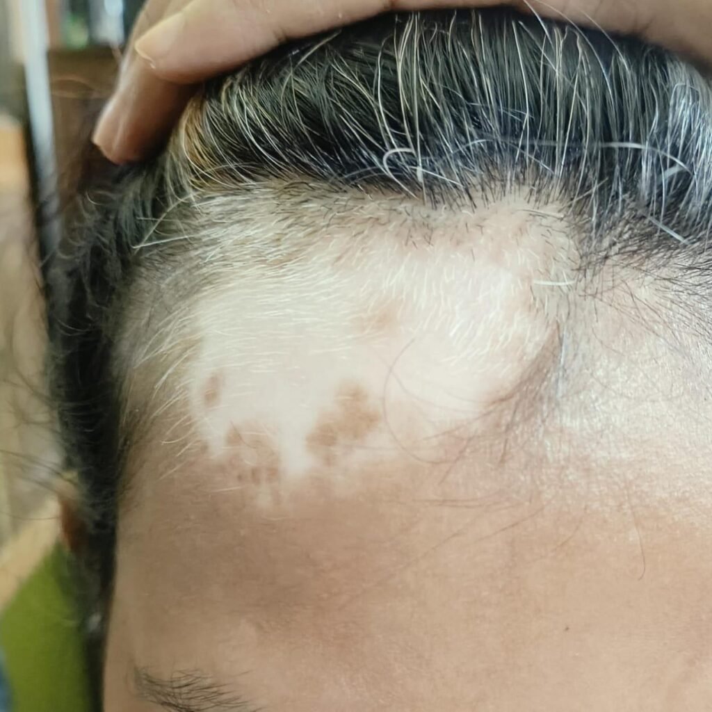 Vitiligo treatment in Patna
