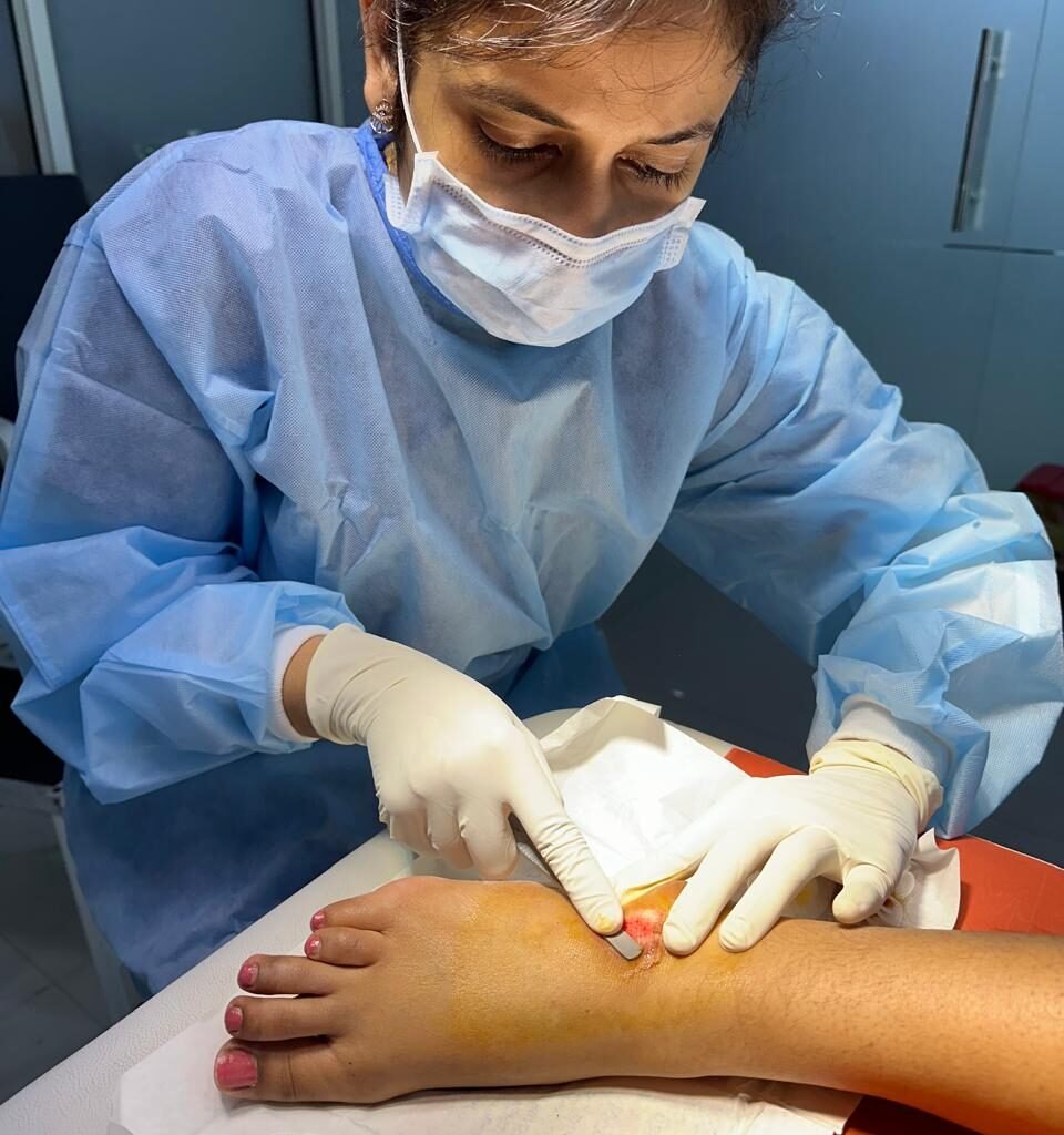 Cell Collection for Vitiligo Treatment