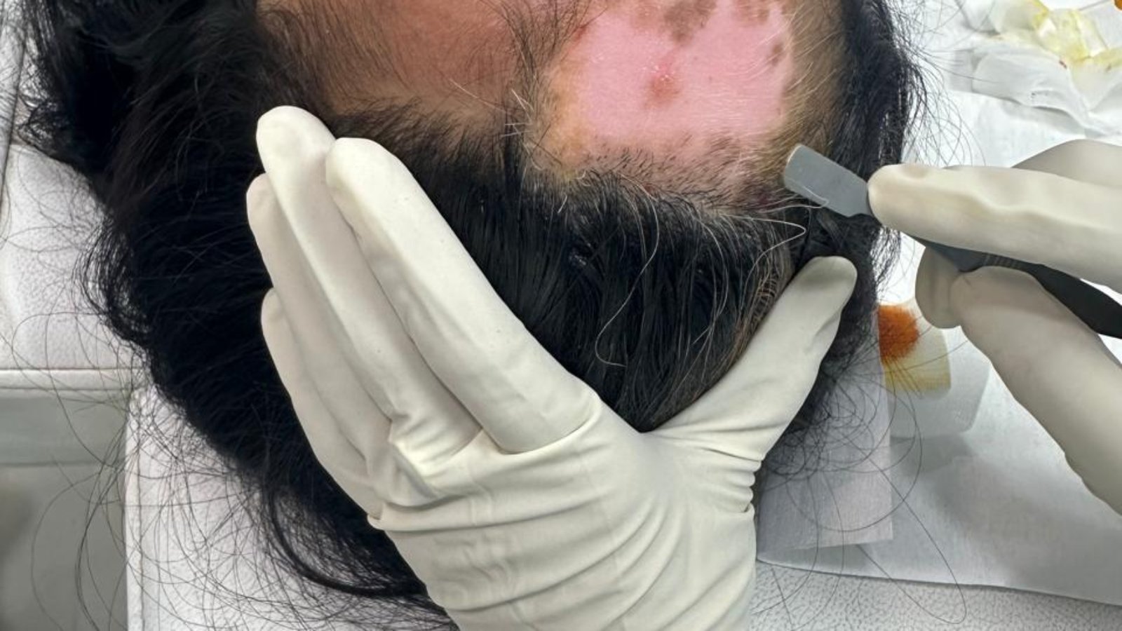 Vitiligo treatment in Patna