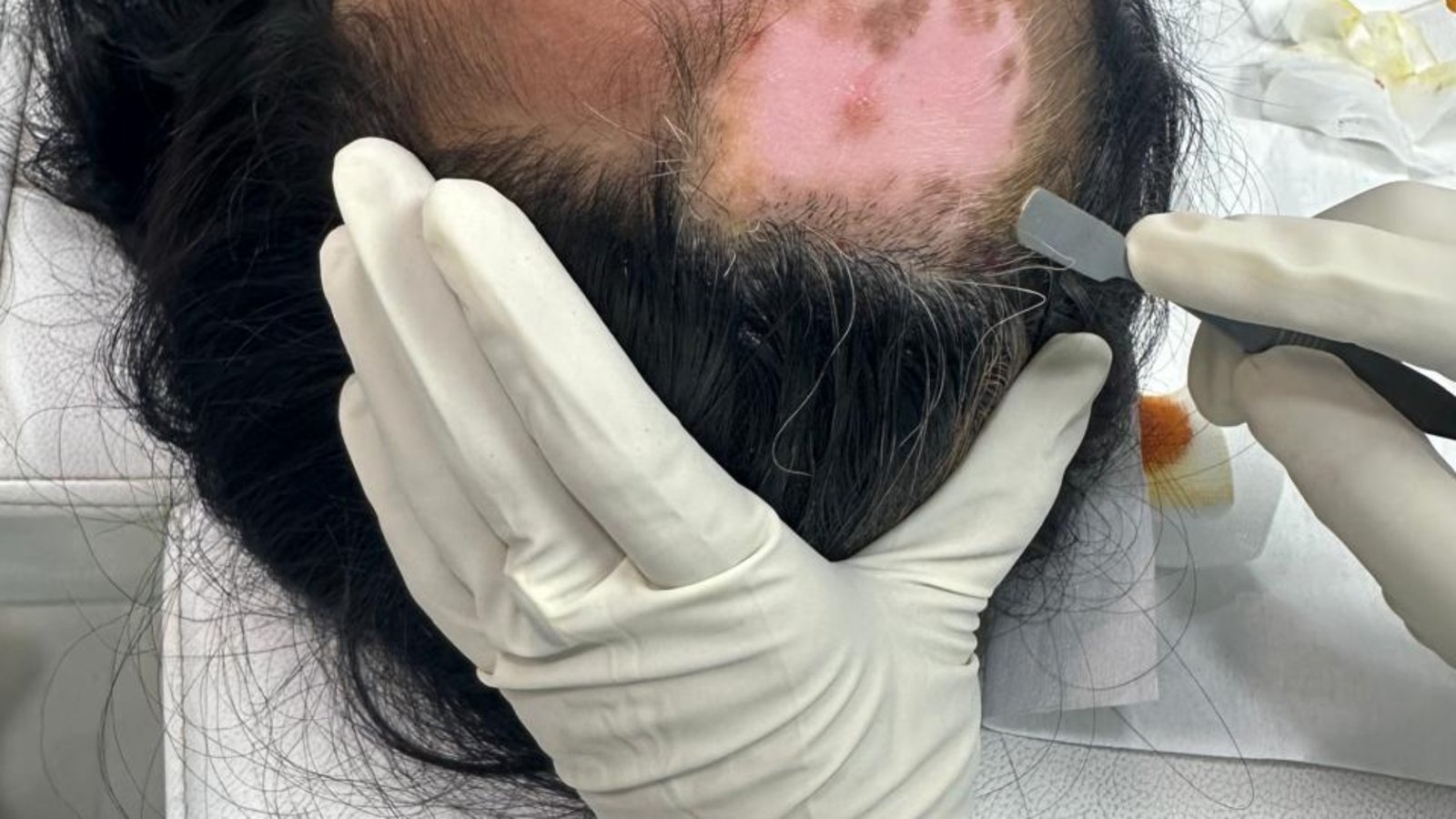 Vitiligo treatment in Patna