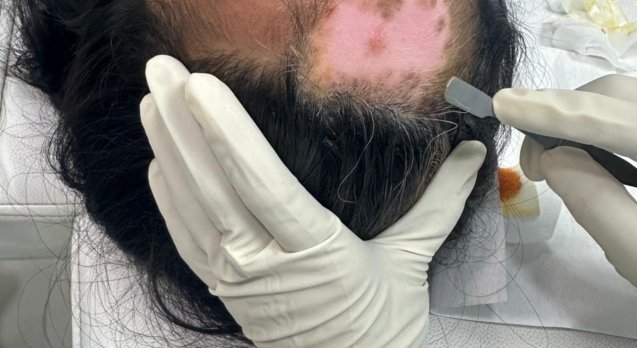Vitiligo treatment in Patna