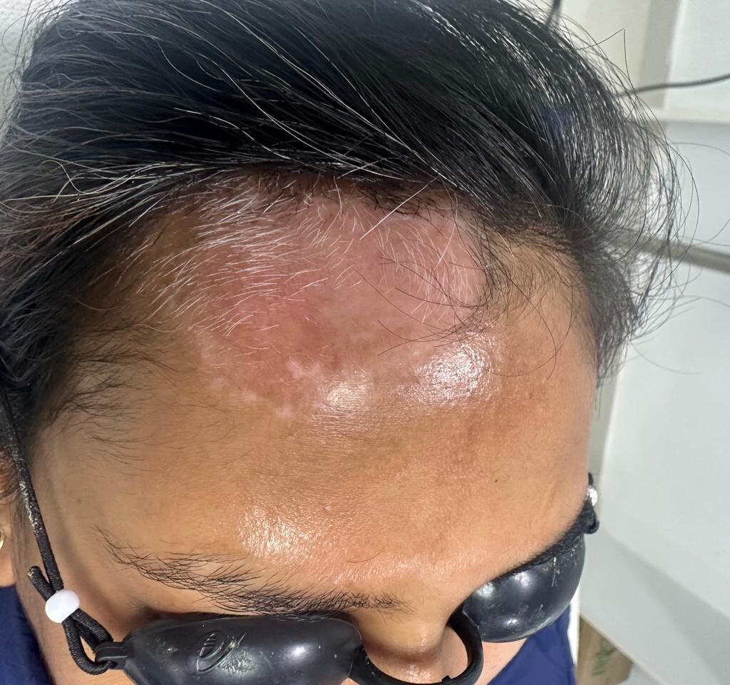 After Vitiligo treatment